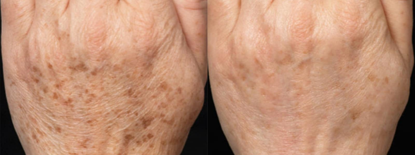 Age Spot Removal Columbia SC