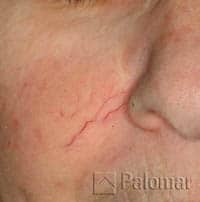 facial vein correction