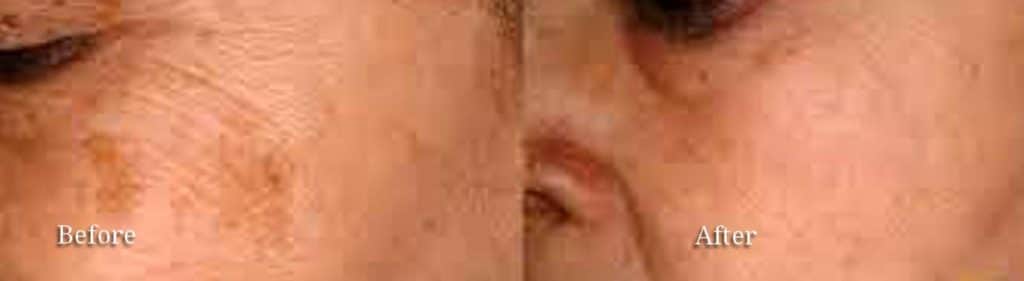 facial vessel correction before and after facial vessel correction columbia sc