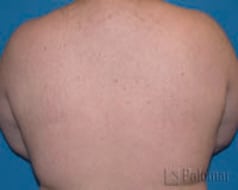 laser hair removal after
