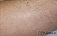 laser hair removal for men