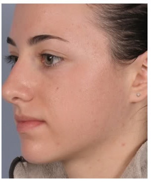 microdermabrasion after