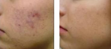 skin peel treatments columbia sc