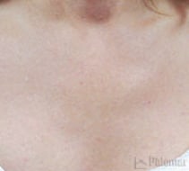 skin rejuvenation to remove spots