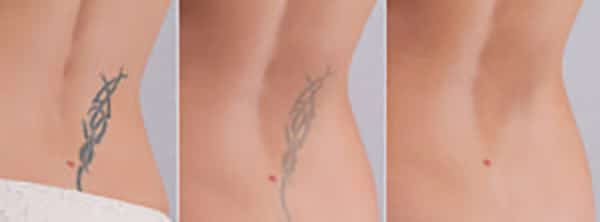 tattoo removal columbia sc