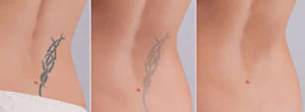 Tattoo Removal in North Myrtle Beach  Touch MedSpa