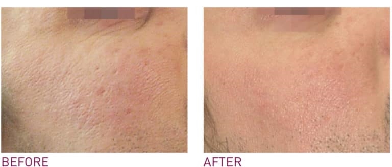 acne scar treatment prx t33
