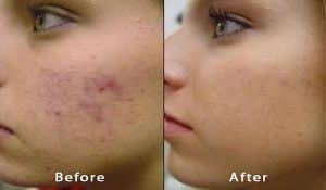 acne treatment Columbia SC